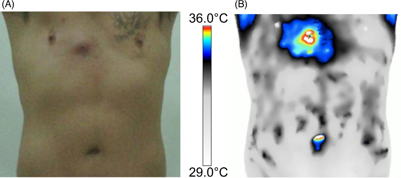 Imagem clínica e térmica de abscesso cutâneo em região torácica.