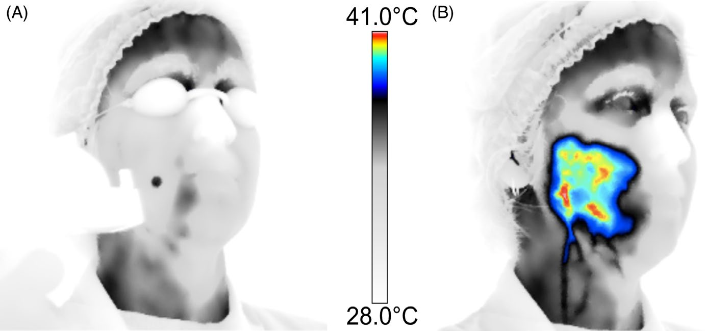 Imagem térmica facial antes e depois de aplicação de laser em tratamento estético.