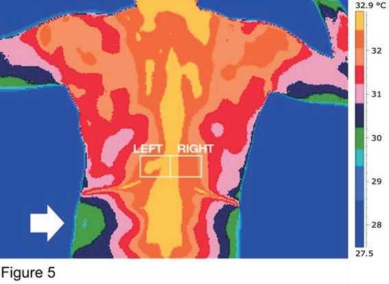 Figura termográfica do relato de caso com regiões de interesse esquerda e direita em topografia paravertebral.