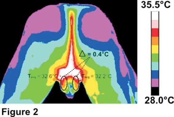 Termograma de coxas proximais e topografia testicular com diferença térmica bilateral.