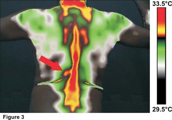 Termograma posterior com foco tóraco-lombar paravertebral esquerdo destacado.