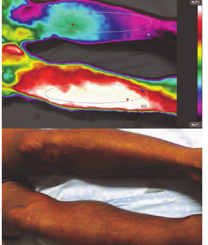 Primeiro termograma do caso mostrando diferença térmica entre os membros inferiores