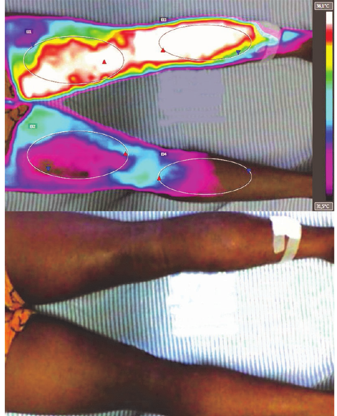 Termograma posterior no fim da terceira semana de hospitalização