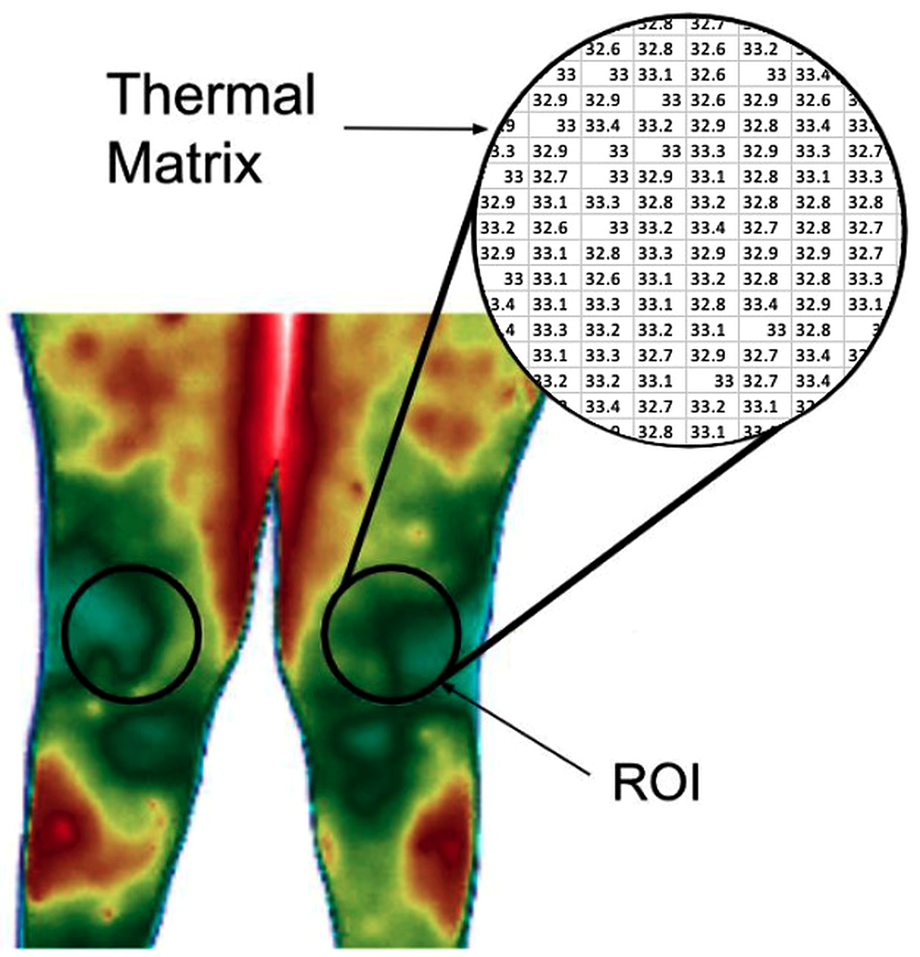 Figura do estudo mostrando termograma dos joelhos, região de interesse e matriz térmica extraída da ROI
