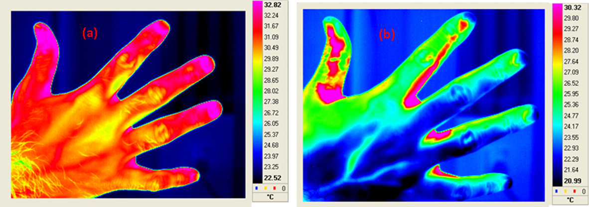 Termogramas de la mano derecha antes y después de estímulo frío leve