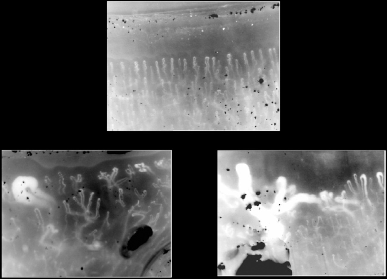 Capilaroscopia de lecho ungueal mostrando patrón normal y microangiopatía en esclerosis sistémica