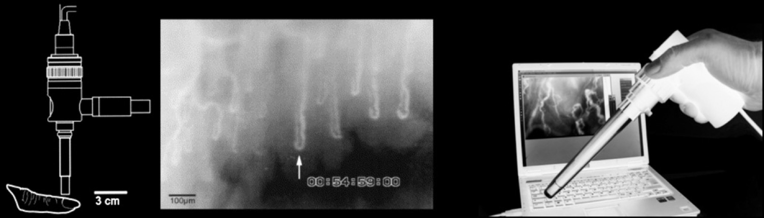 Sistema de capilaroscopia del lecho ungueal con sonda, imagen capilar e interfaz de adquisición