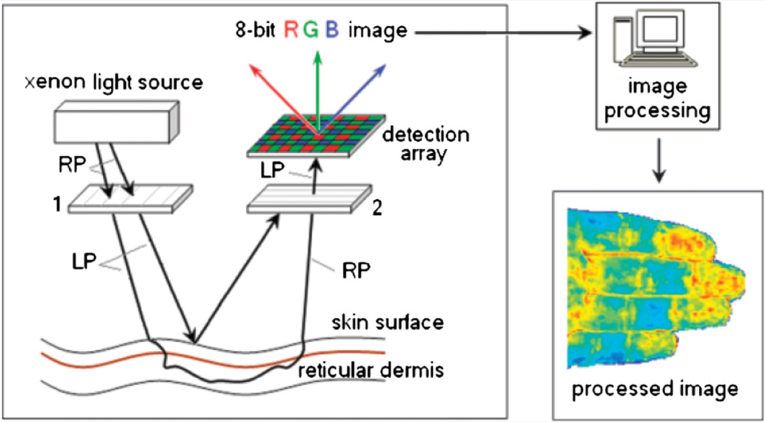 Esquema de Tissue Viability Imaging demostrando iluminación, detección RGB e imagen procesada